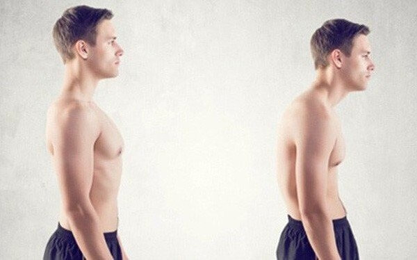 Bài tập khắc phục lưng tôm cho người bị gù lưng